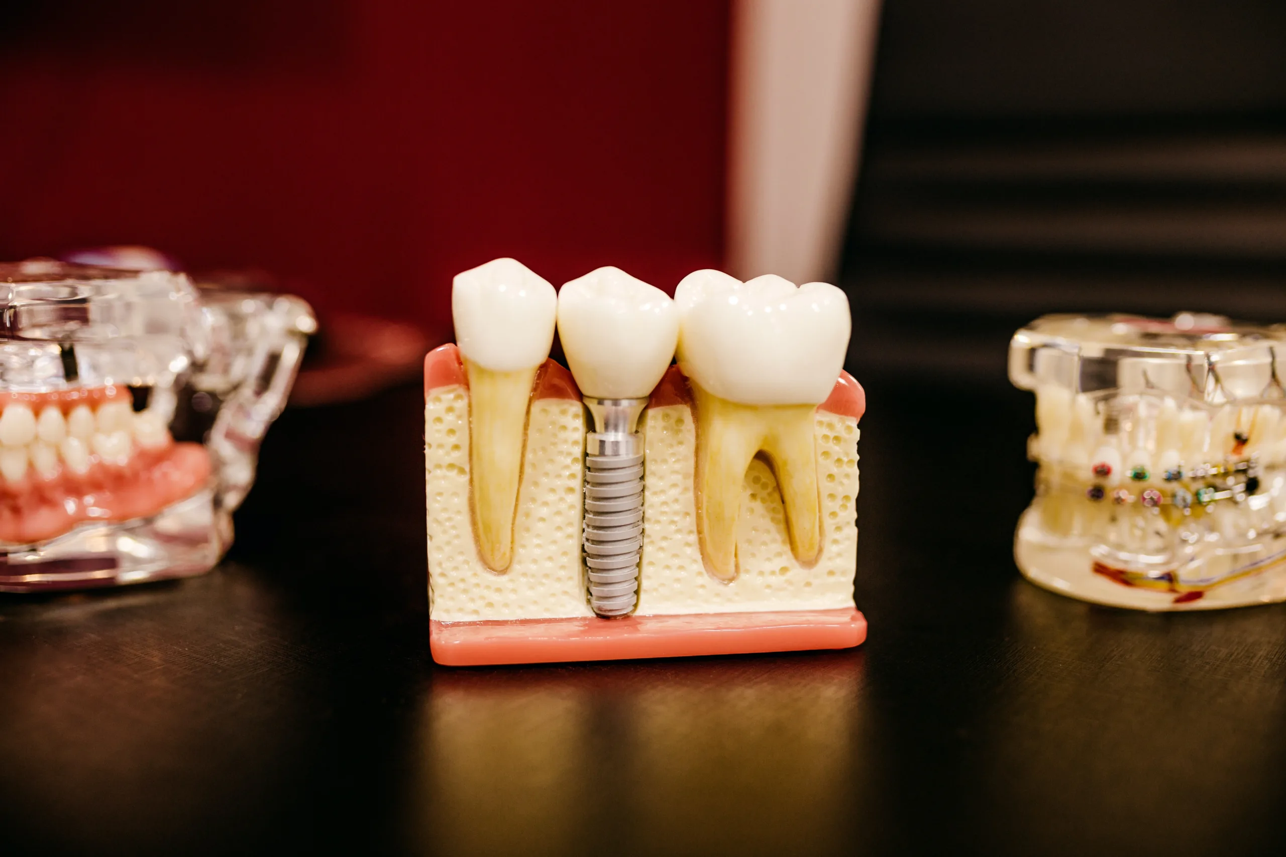 Does Medicare cover Dental Implants?